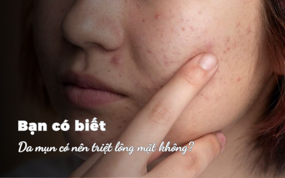 Da mụn có nên triệt lông mặt không?