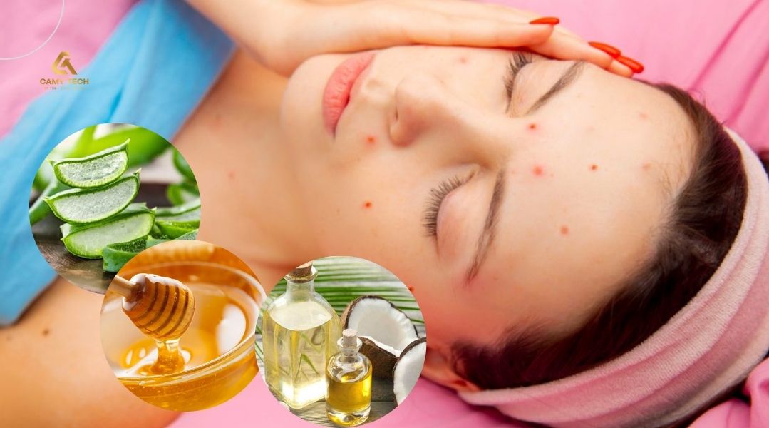 Cách trị sẹo thủy đậu trên mặt bằng nguyên liệu thiên nhiên