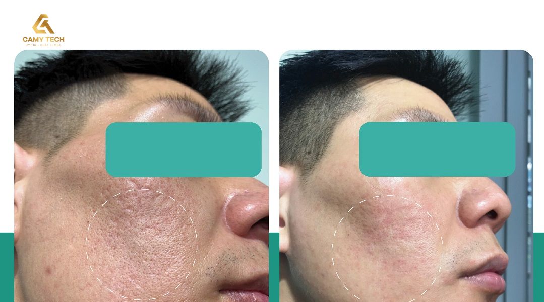 Chăm sóc da đúng cách sau điều trị giúp tăng khả năng tái tạo da