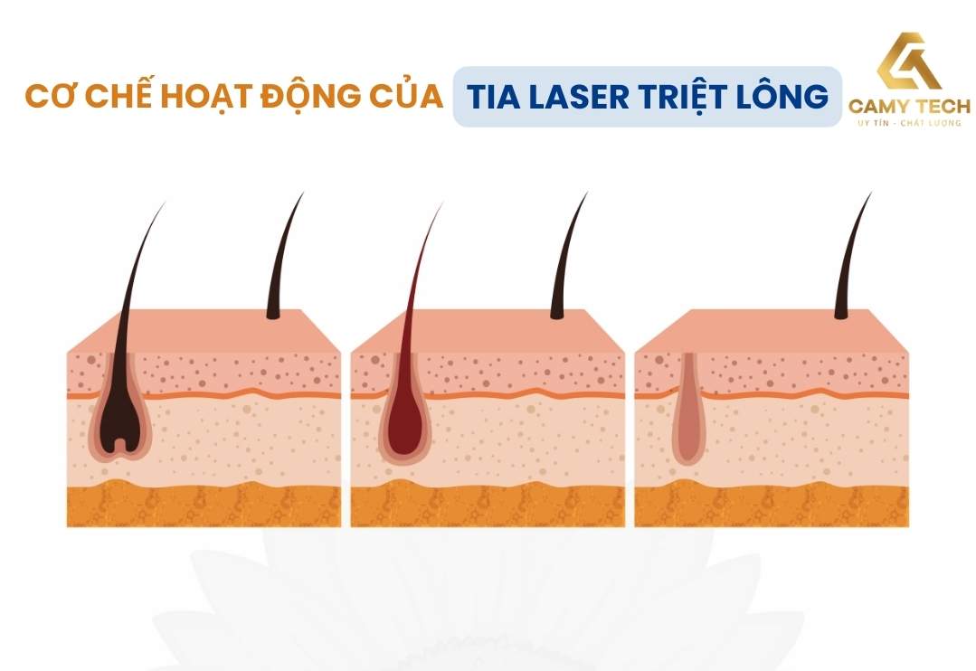 Triệt lông bằng laser phá hủy nang lông từ gốc khiến lông yếu đi, mọc chậm lại