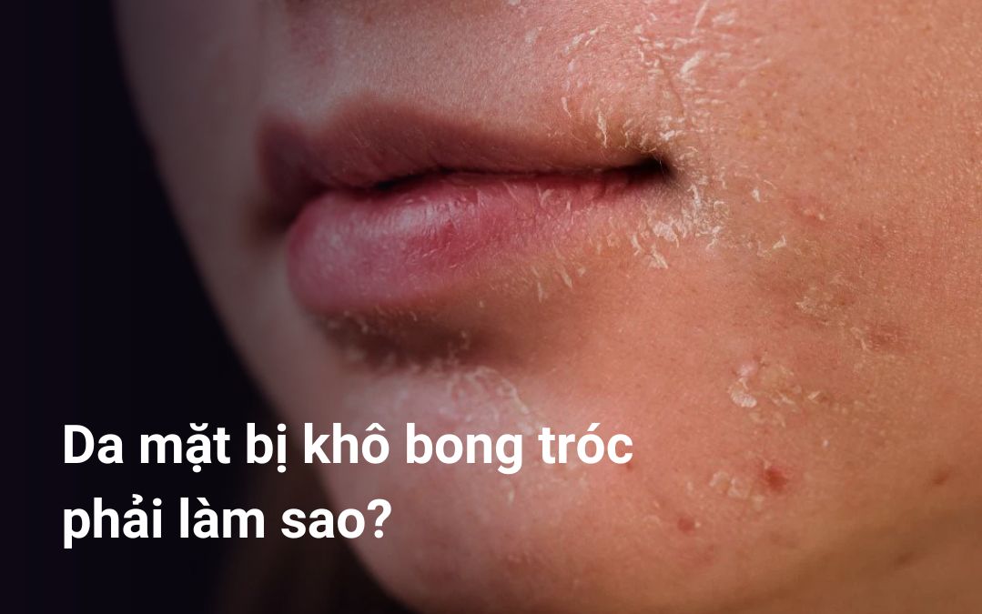 Da khô bị bong tróc phải làm sao?