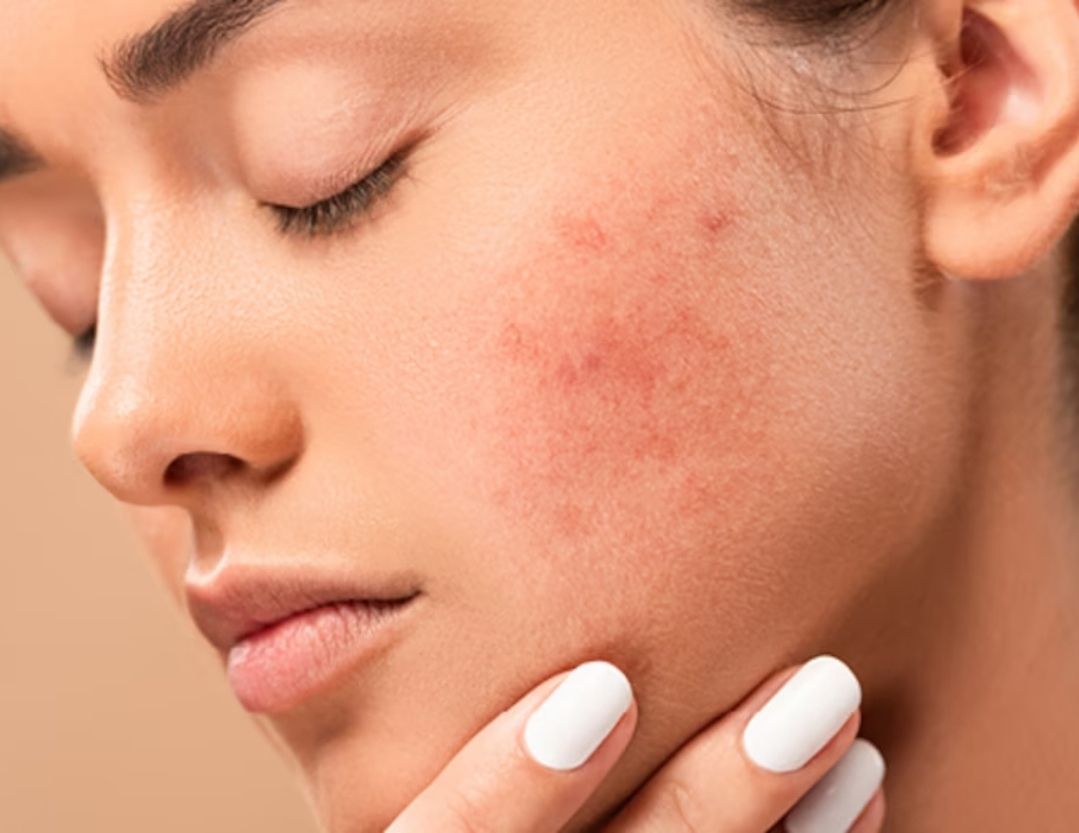 Da mặt bị ngứa châm chích phải làm sao?