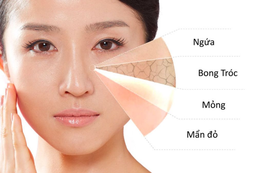 Các dấu hiệu nhận biết da nhiễm corticoid