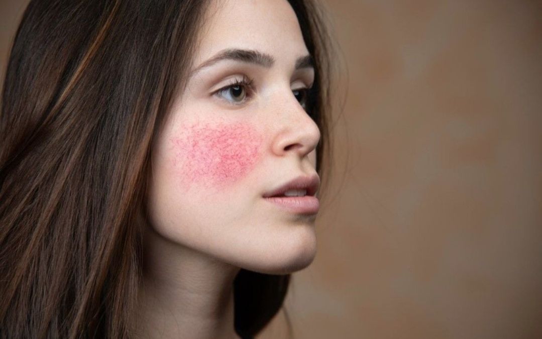 Hình ảnh soi da bị nhiễm corticoid mức độ 1