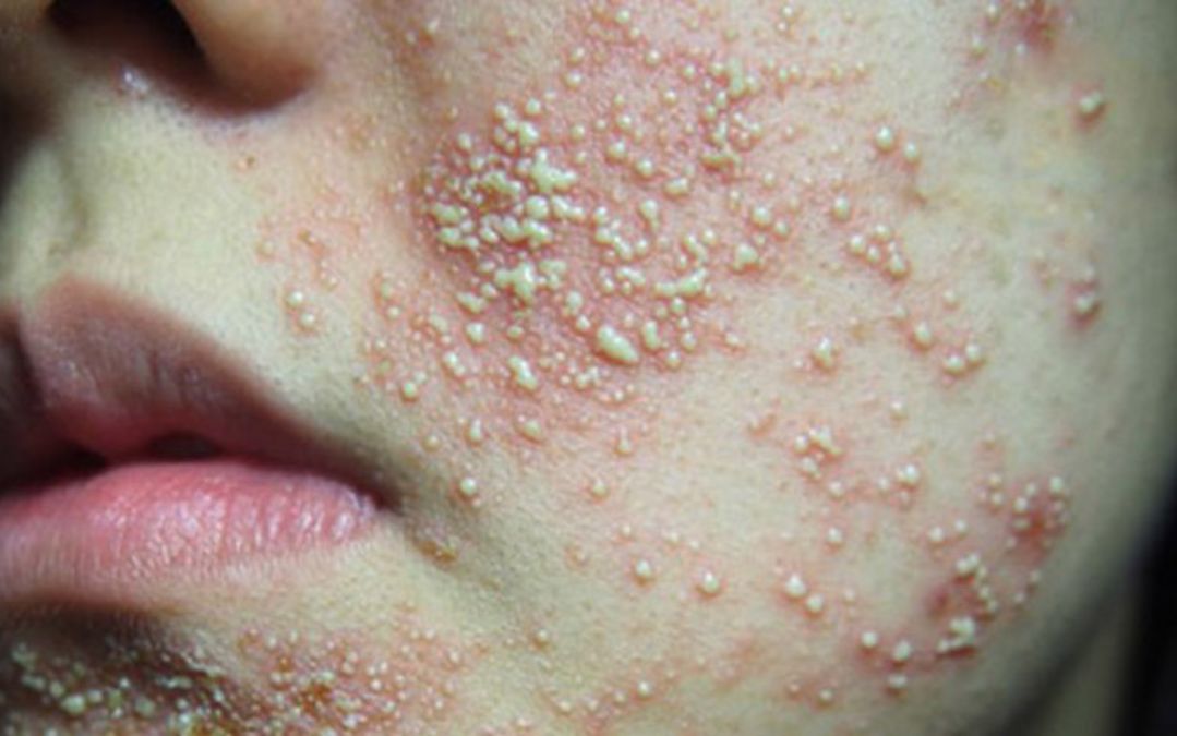 Hình ảnh mức độ nhiễm corticoid nặng nhất