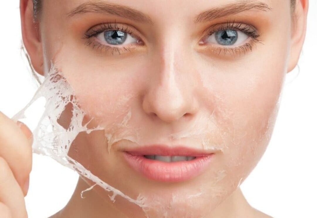 Peel da chính là phương pháp có thể điều trị được sẹo rỗ