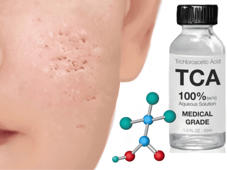 Phương pháp PEEL TCA giúp điều trị sẹo rỗ hiệu quả