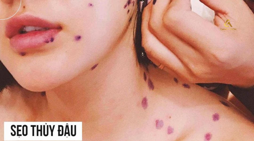 Sẹo thủy đậu là gì?