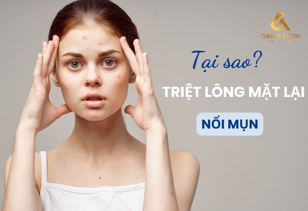 Tìm hiểu nguyên nhân tại sao triệt lông mặt lại nổi mụn