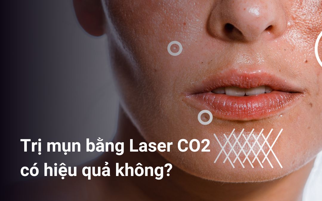Trị mụn bằng laser CO2 có hiệu quả không?