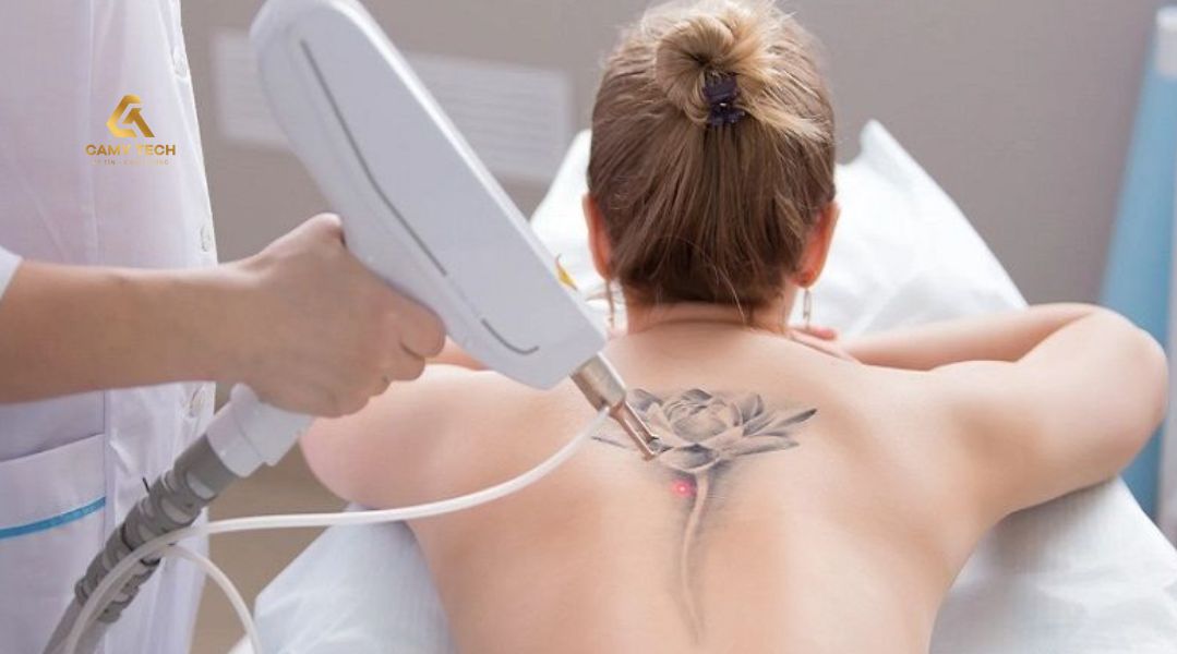 Xăm mình có triệt lông được không? Cần lưu ý những gì?