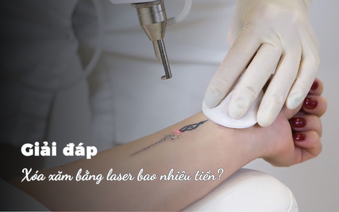 Xóa xăm bằng laser bao nhiêu tiền?