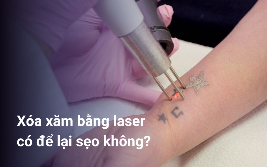 Xóa xăm bằng laser có để lại sẹo không?