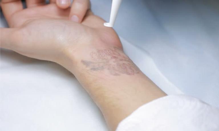 xóa xăm không hết sau khi bắn tia laser